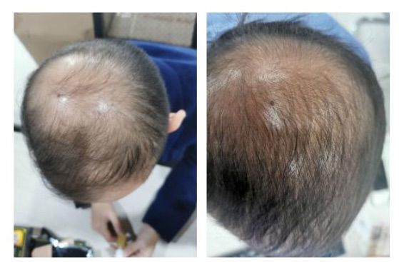 Sérum croissance extrême - Microneedling